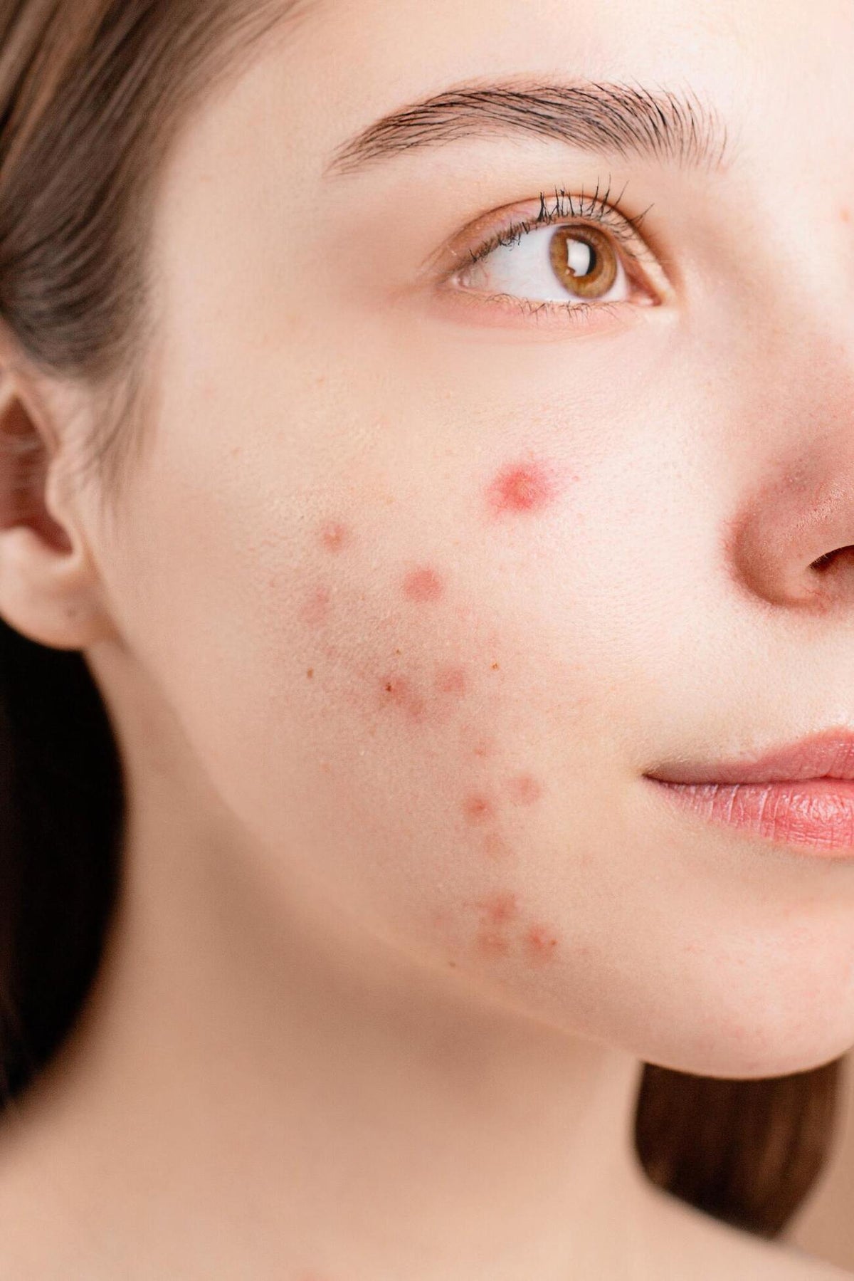 Girl with acne. Shop Korean skincare products to get rid of acne at luxifice.com
