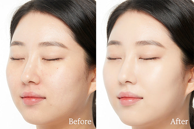 The Role of Korean Skincare in Acne: Techniques and Products for Acne Free Skin